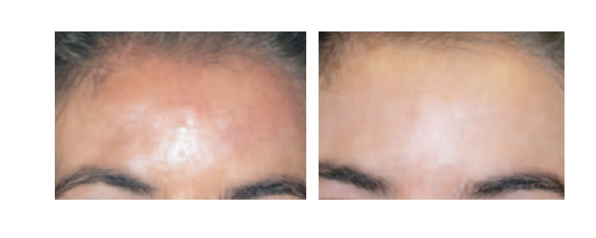 HIPERPIGMENTACIONES MELASMA 3